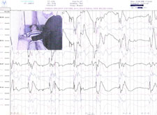 Child Undergoing EEG